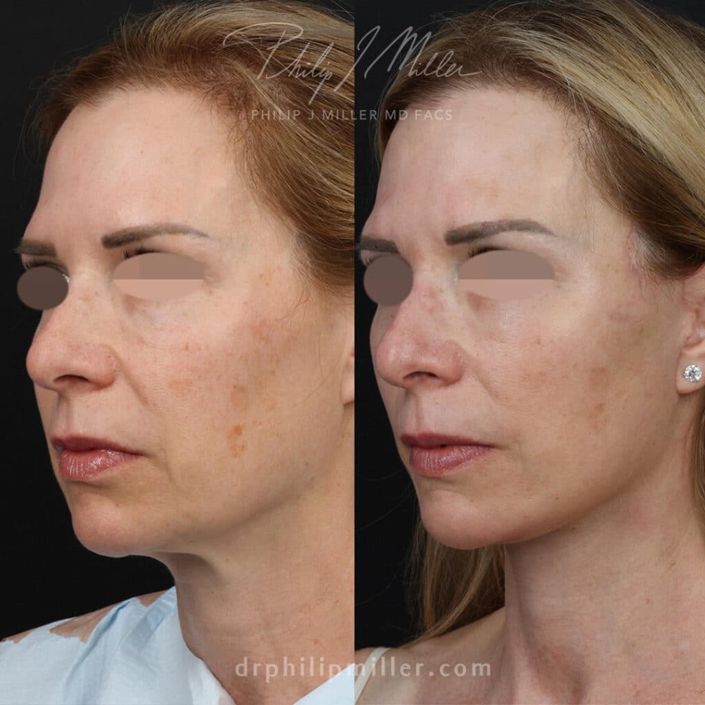 facelift after weight loss results