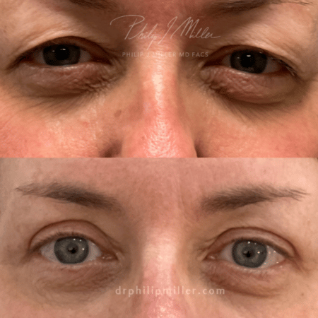 blepharoplasty patient before and after