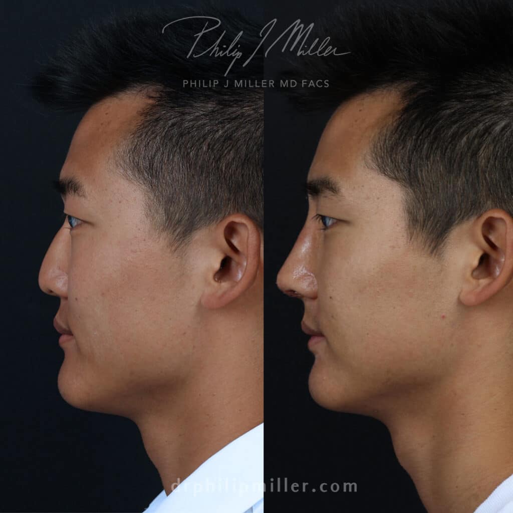 low nasal bridge correction with rhinoplasty before and after