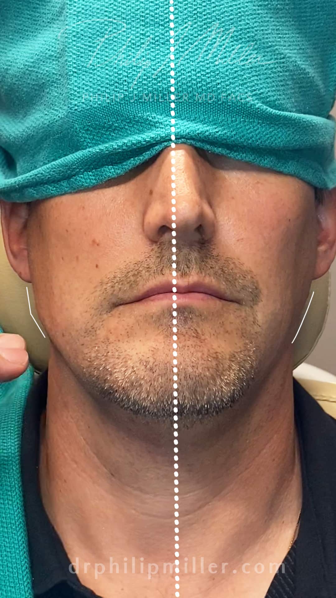 male jawline augmentation in new york results