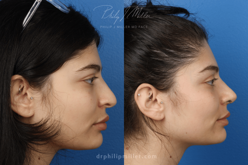 indian rhinoplasty patient