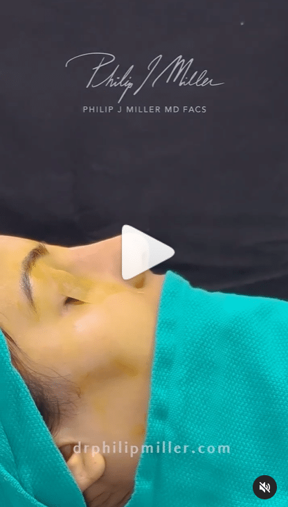 dorsal hump removal procedure