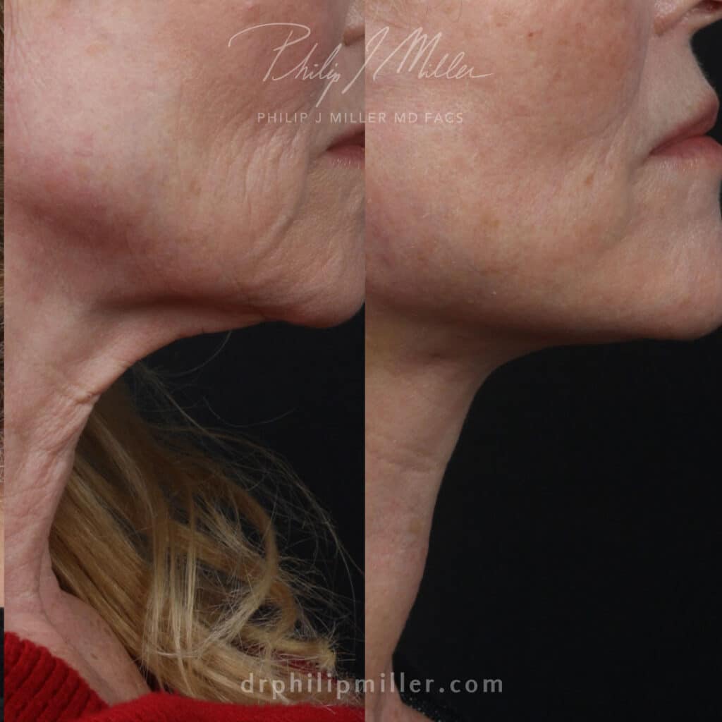 midface lift surgery results in nyc