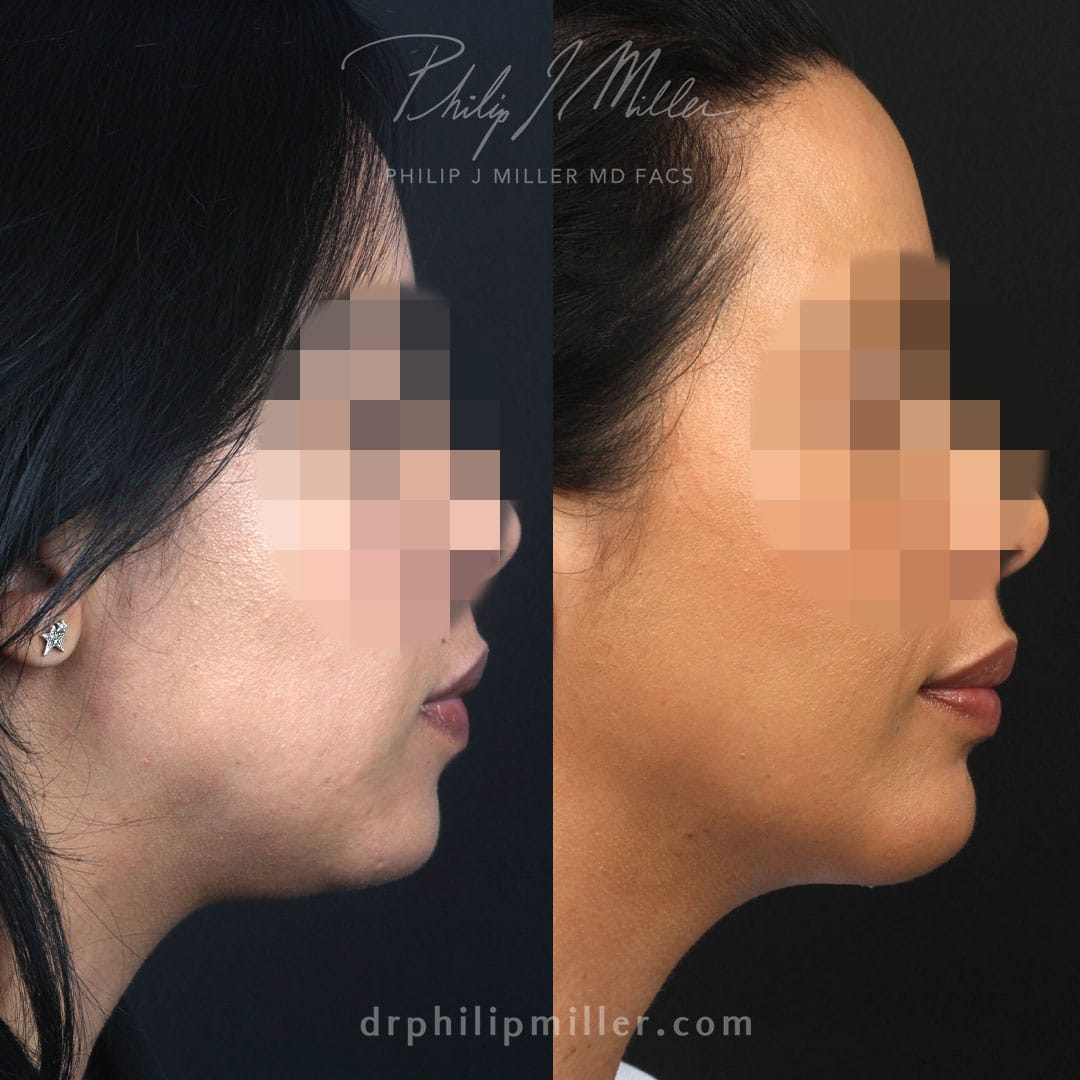 neck lipo for jawline contouring in new york