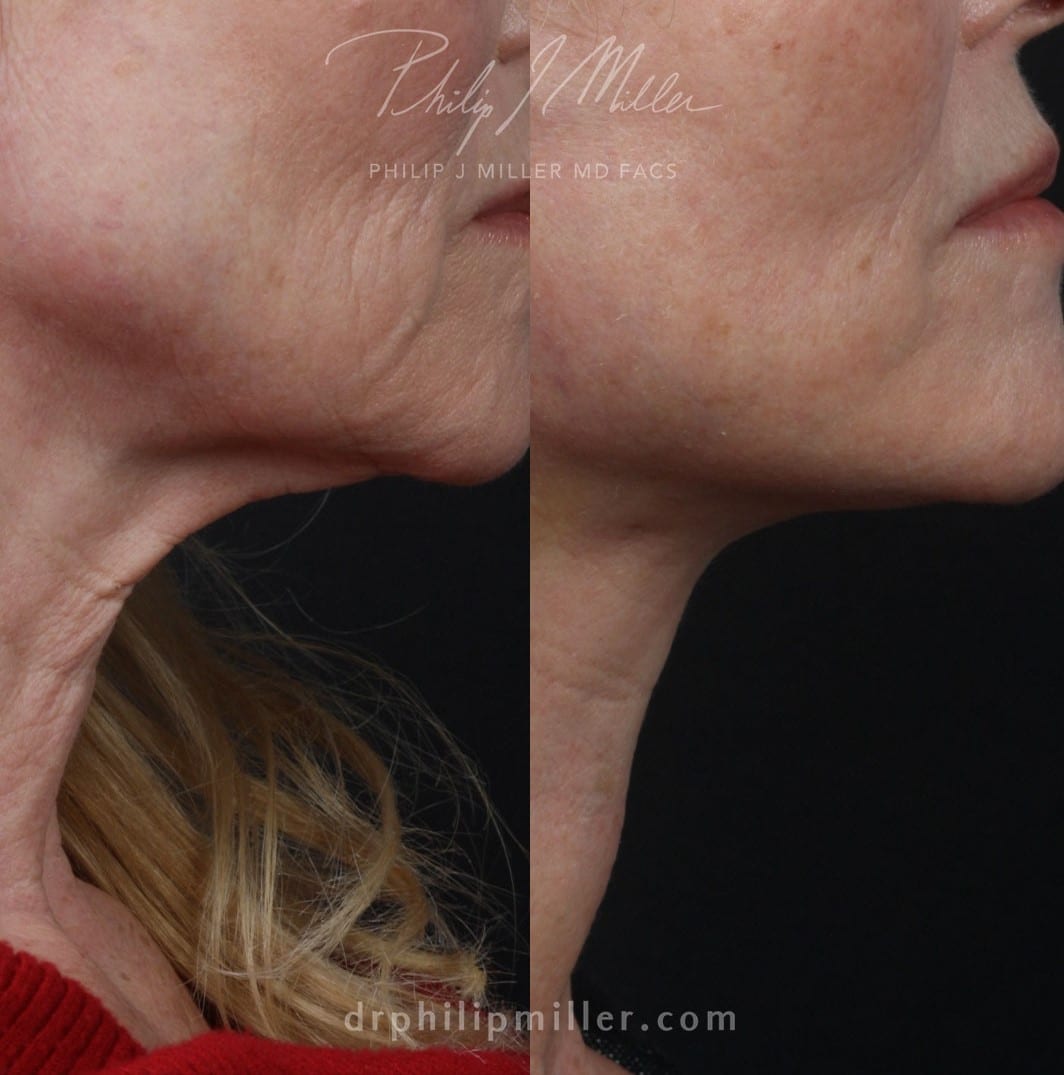 Facelift to address sagging skin on lower face and neck of a female patient by Dr. Miller. After surgery, lines around mouth and jawline are gone and neck looks firmer and more sculpted.