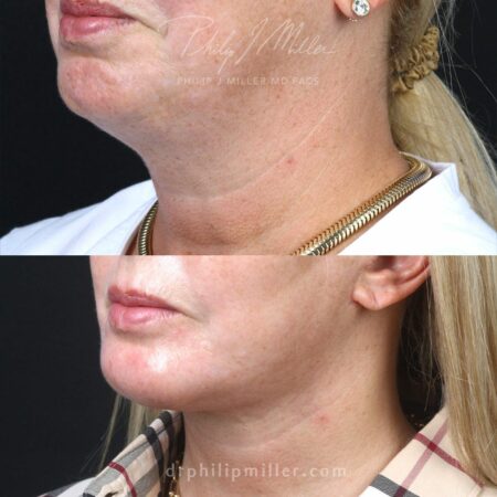 Facelift with chin implant to contour the lower face of a female patient by Dr. Miller