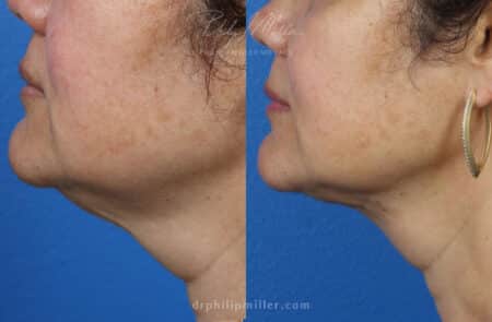 My Ellevate to tighten and sculpt the jawline, by Dr. Miller