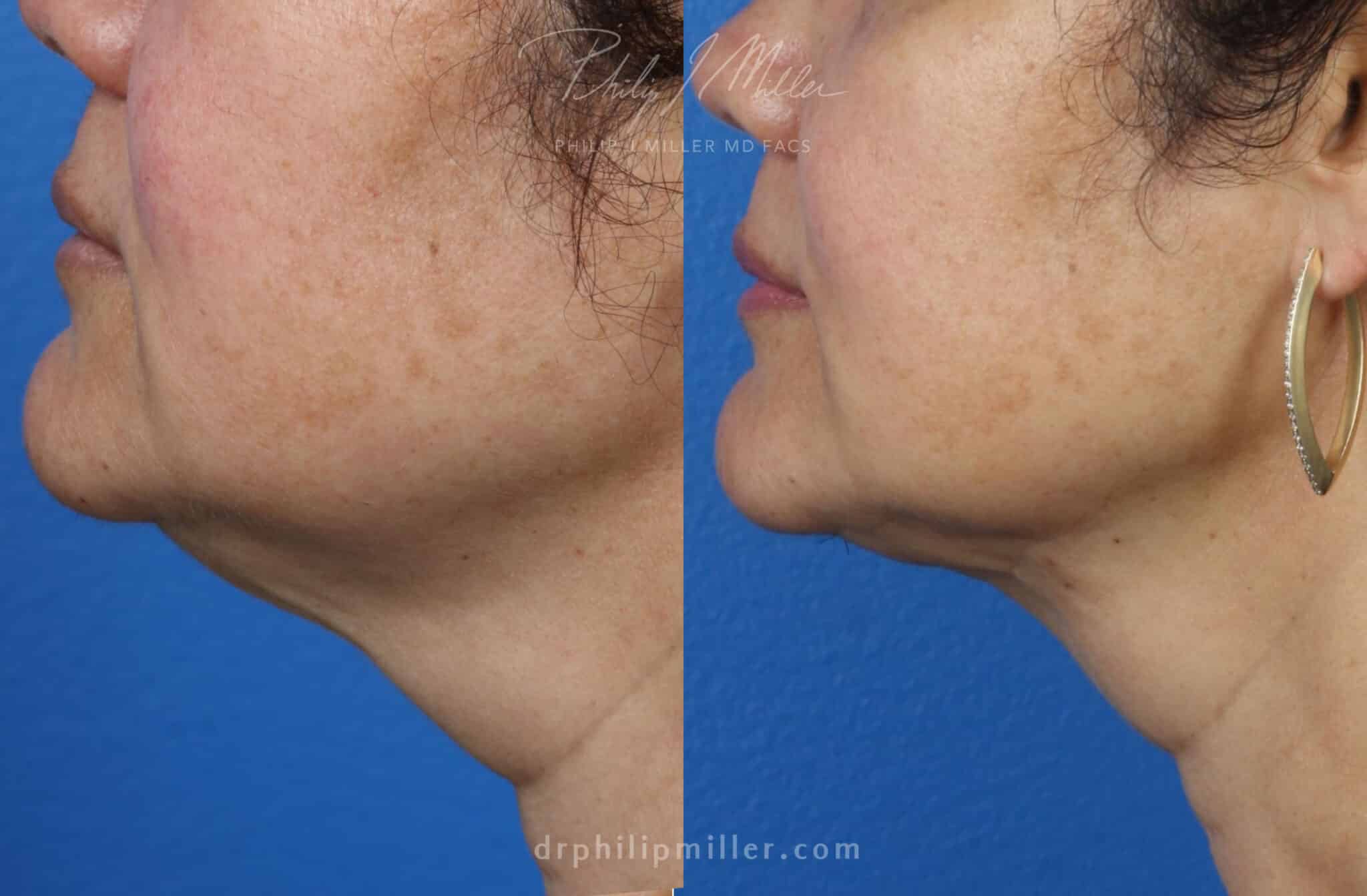 double chin removal results before and after