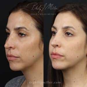 saddle nose surgery after rhinoplasty in nyc