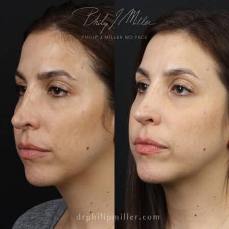 Rhinoplasty to correct a saddle nose on a female patient by Dr. Miller