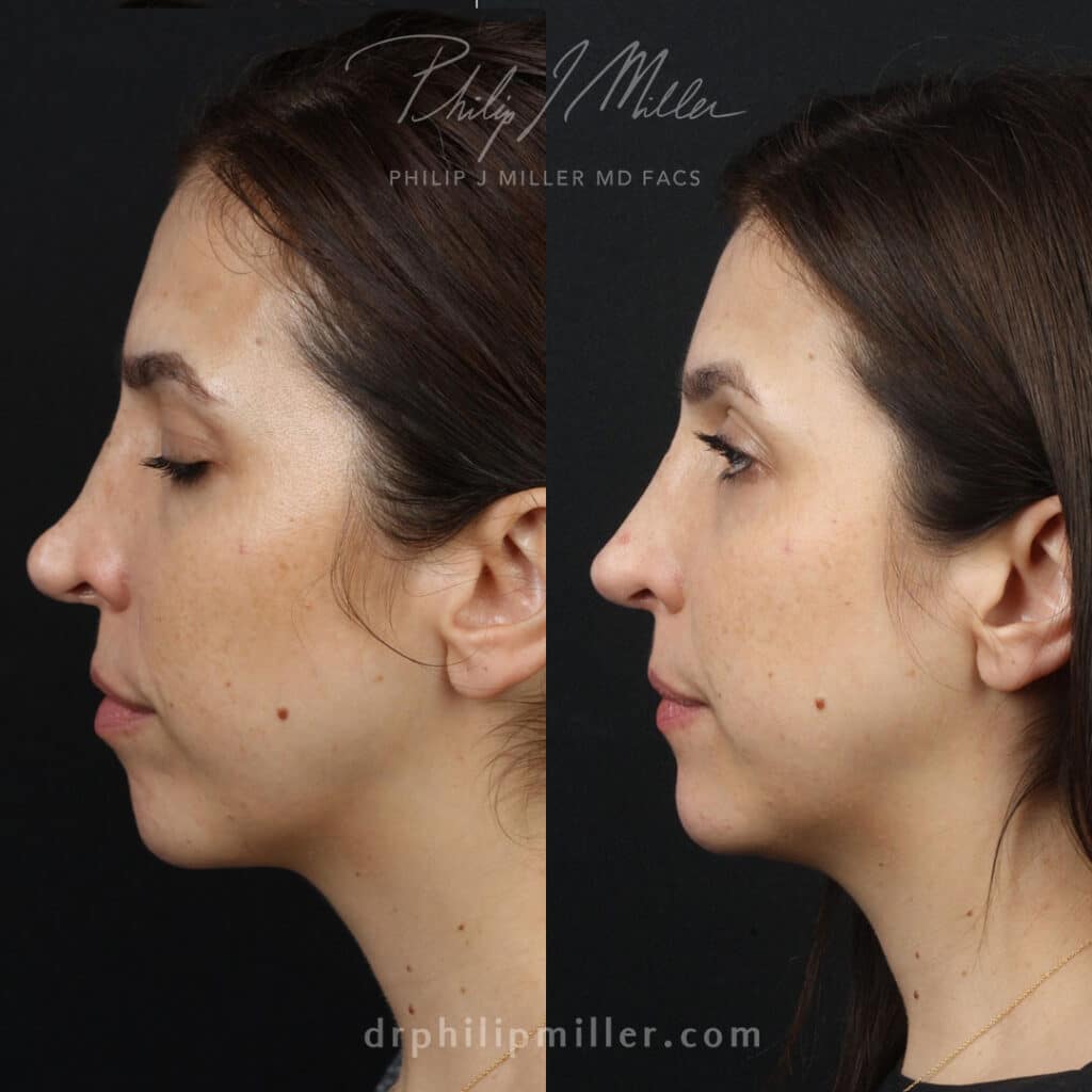 saddle nose deformity correction in new york