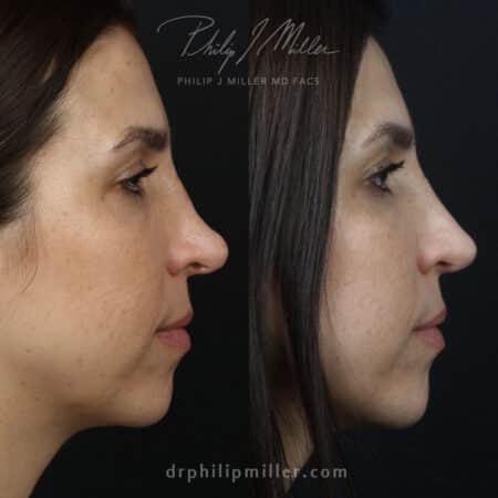 Rhinoplasty to correct a saddle nose on a female patient by Dr. Miller