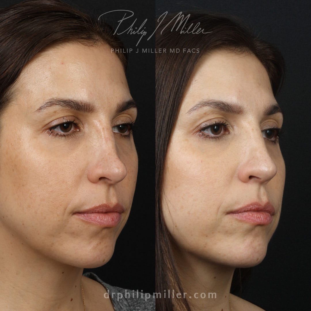 Rhinoplasty to correct a saddle nose on a female patient by Dr. Miller. After surgery, the nasal bridge is straighter and the tip is slightly lifted.