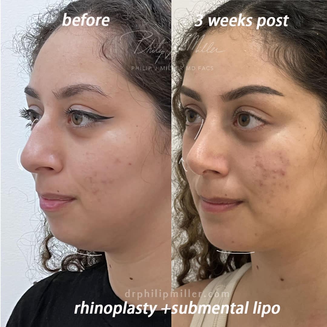 rhinoplasty + neck liposuction results on a female patient