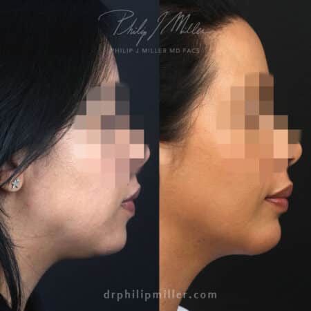 Chin implant, submental liposuction, NeckTite, and MyEllevate to contour jawline by Dr. Miller