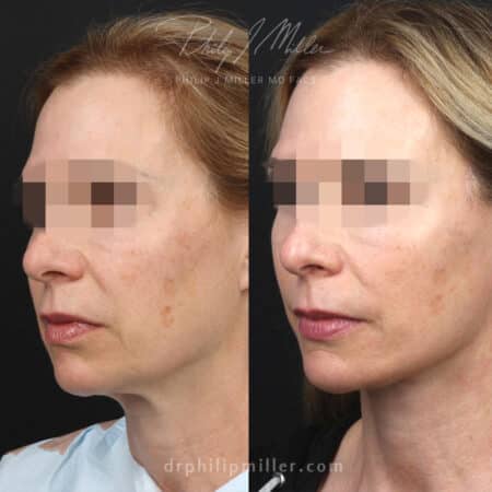 Facelift and neck lift to rejuvenate lower face of a female patient by Dr. Miller