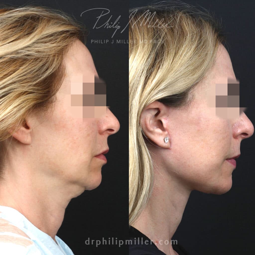 Facelift and neck lift to rejuvenate lower face of a female patient by Dr. Miller. Surgery creates more defined jawline and smoother contour from the lower face to the neck.
