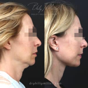 Facelift and neck lift to rejuvenate lower face of a female patient by Dr. Miller. Surgery creates more defined jawline and smoother contour from the lower face to the neck.
