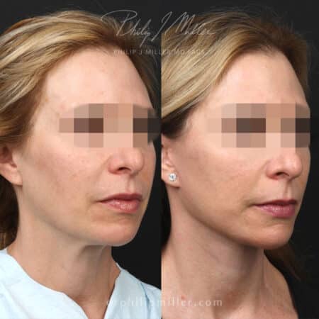 Facelift and neck lift to rejuvenate lower face of a female patient by Dr. Miller