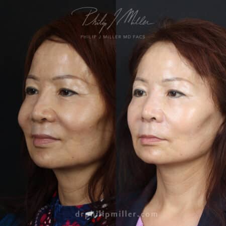 Facelift to restore a youthful facial contour on a female patient by Dr. Miller