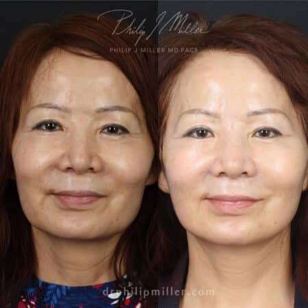 Facelift to restore a youthful facial contour on a female patient by Dr. Miller