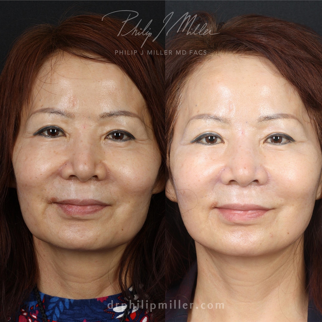 Mini Facelift in New York City - Philip Miller MD