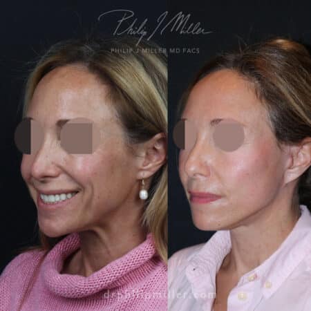 Facelift to define jawline and create a more youthful appearance for a female patient by Dr. Miller