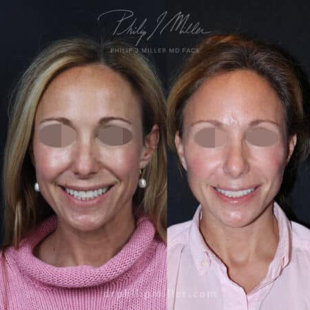 Facelift to define jawline and create a more youthful appearance for a female patient by Dr. Miller