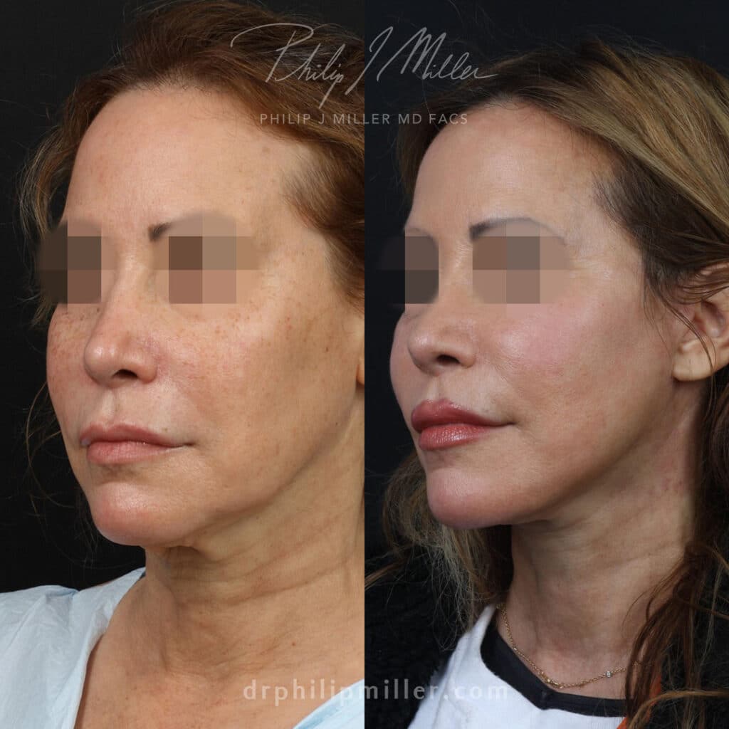 Facelift to rejuvenate the appearance of a female patient by Dr. Miller. After surgery, jawline is more defined and jowls are gone.