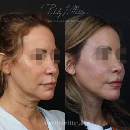 Facelift to rejuvenate the appearance of a female patient by Dr. Miller