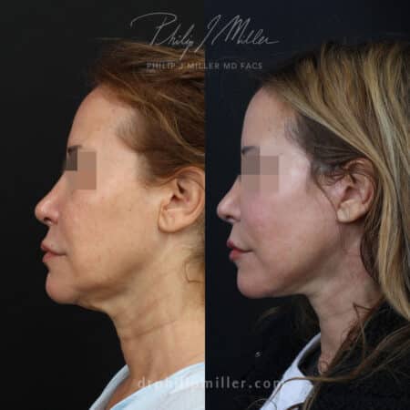 Facelift to rejuvenate the appearance of a female patient by Dr. Miller