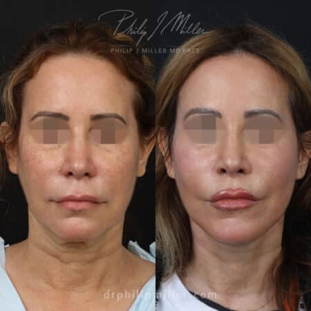 Facelift to rejuvenate the appearance of a female patient by Dr. Miller