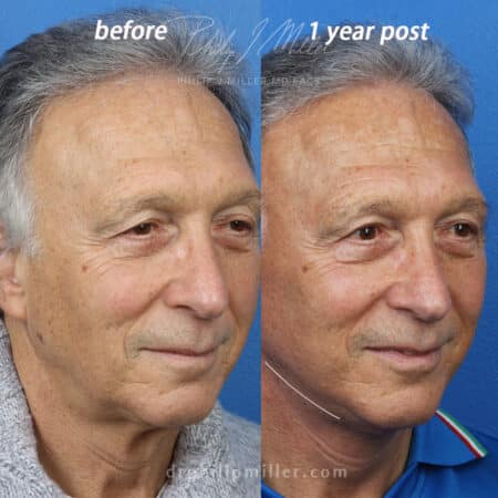 Facelift to rejuvenate the appearance of a male patient by Dr. Miller