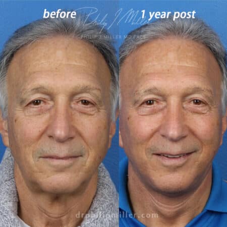 Facelift to rejuvenate the appearance of a male patient by Dr. Miller