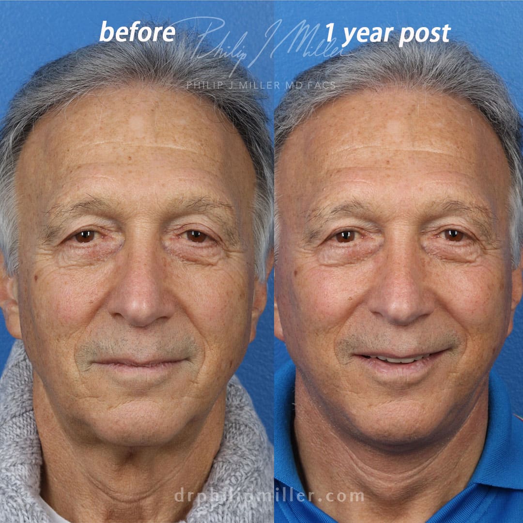 Facelift to rejuvenate the appearance of a male patient by Dr. Miller. After surgery, skin looks firmer, jawline is more defined, and patient looks more youthful.