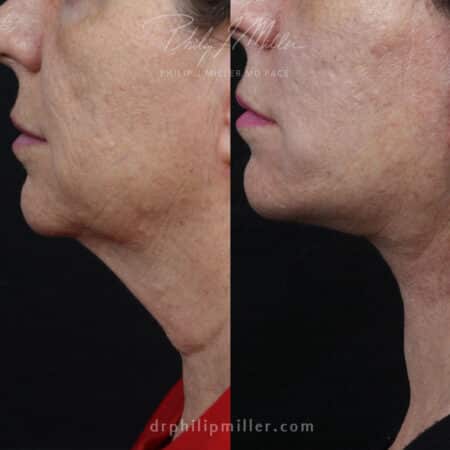 Facelift to treat sagging skin on the lower face and neck of a female patient by Dr. Miller