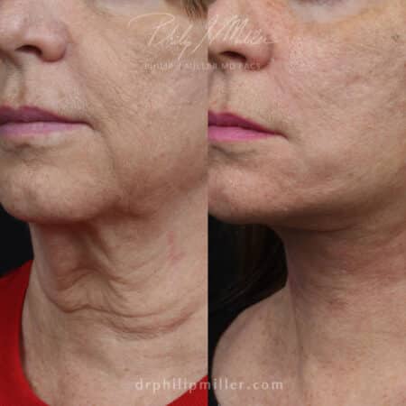 Facelift to treat sagging skin on the lower face and neck of a female patient by Dr. Miller