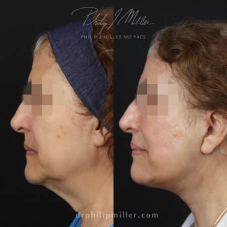 Facelift with facial fat grafting to rejuvenate the appearance of a female patient by Dr. Miller