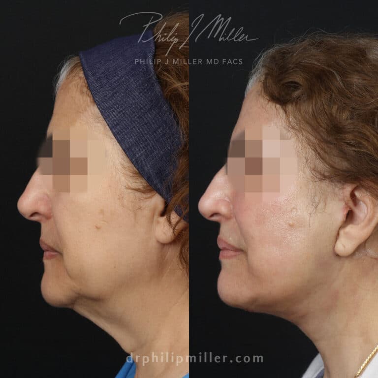 Facelift with facial fat grafting to rejuvenate the appearance of a female patient by Dr. Miller. Surgery creates a more defined jawline, fuller cheeks, and a more youthful appearance.