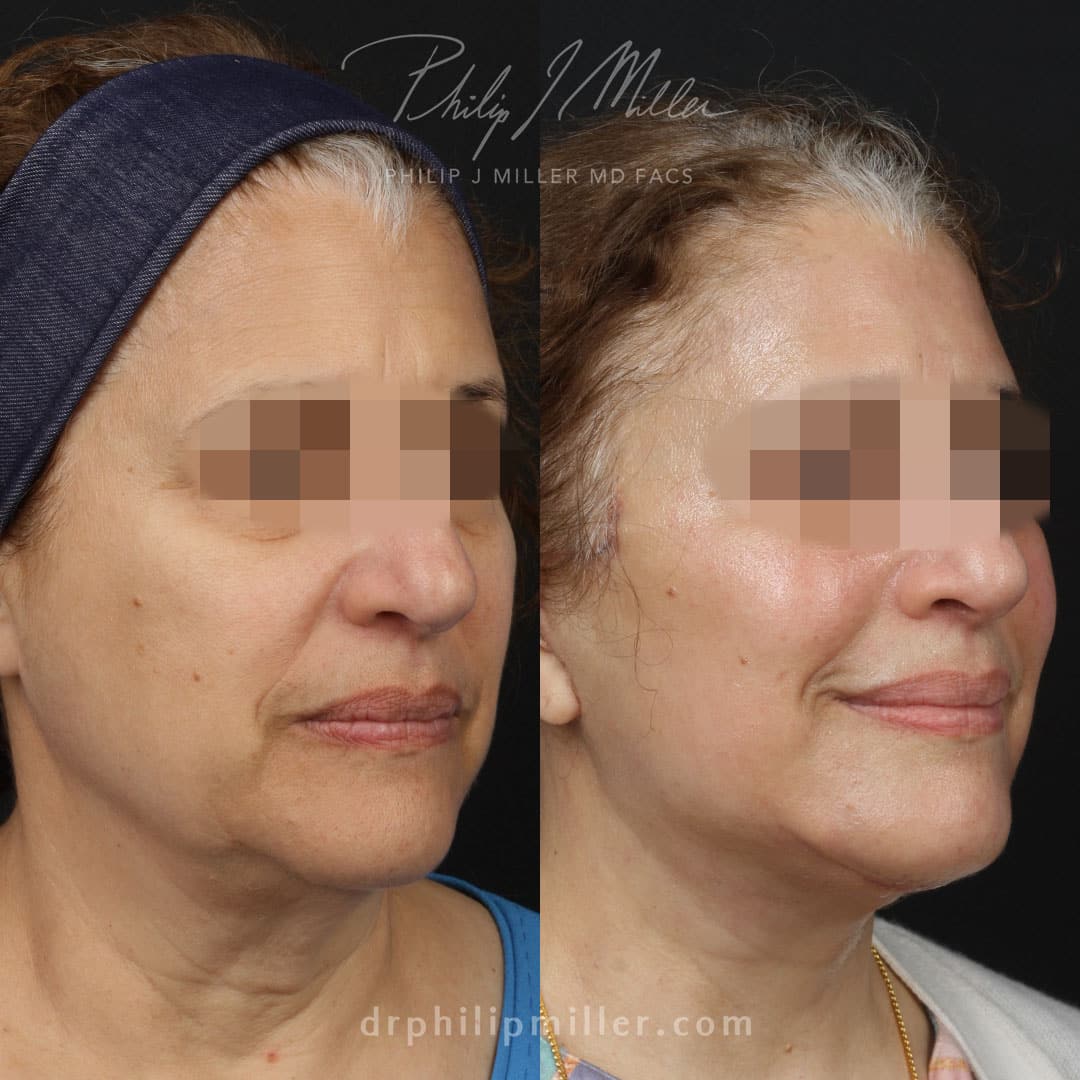 Facelift with facial fat grafting to rejuvenate the appearance of a female patient by Dr. Miller. Surgery creates a more defined jawline, fuller cheeks, and a more youthful appearance.