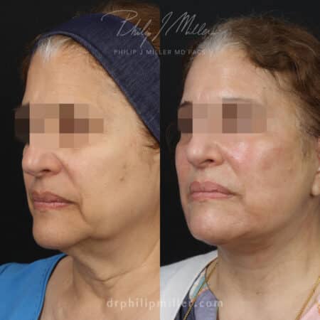 Facelift with facial fat grafting to rejuvenate the appearance of a female patient by Dr. Miller