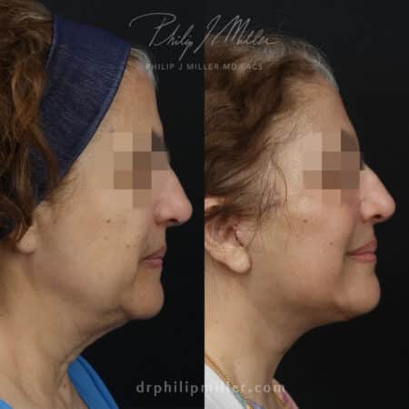 Facelift with facial fat grafting to rejuvenate the appearance of a female patient by Dr. Miller