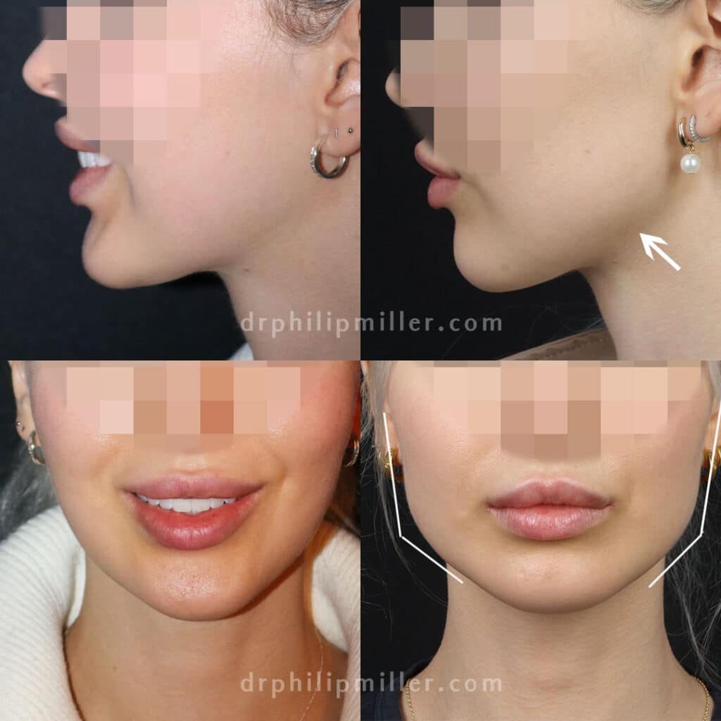 Jaw implants to contour the jawline of a female patient by Dr. Miller. Surgery creates stronger, more defined jawline.