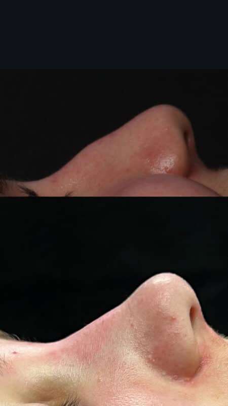 MicroRhinoplasty to remove dorsal hump from nasal bridge by Dr. Miller