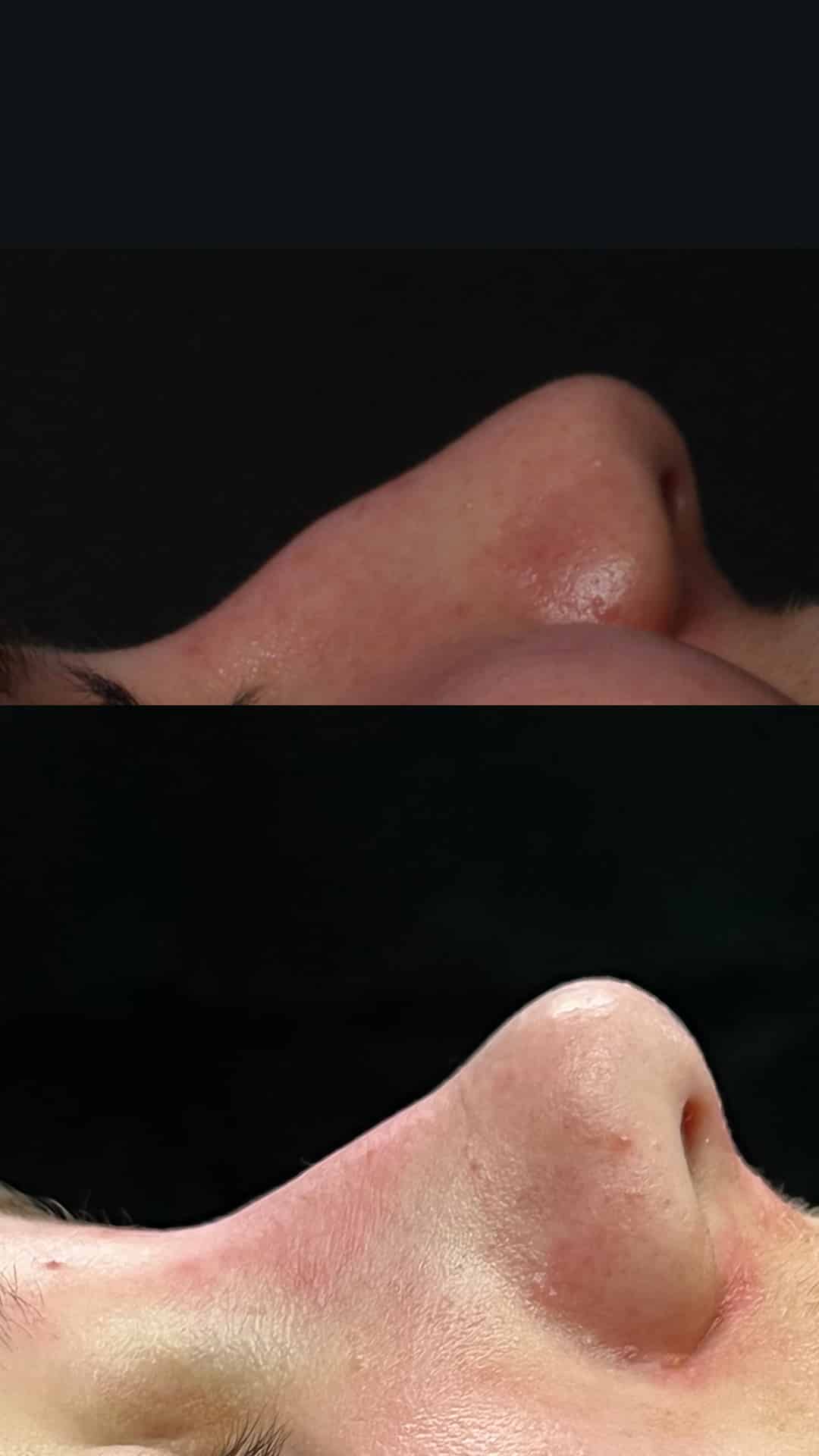 MicroRhinoplasty to remove dorsal hump from nasal bridge by Dr. Miller. After surgery, bump is gone and nasal bridge is straighter.