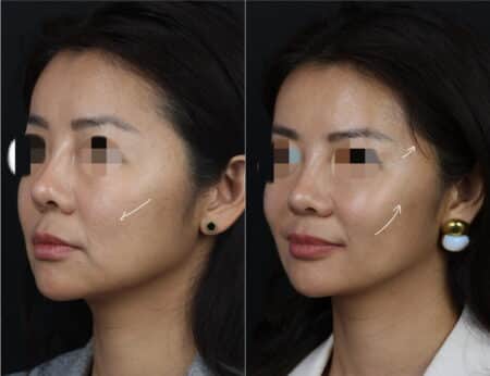 Microlift to rejuvenate the midface of a female patient by Dr. Miller