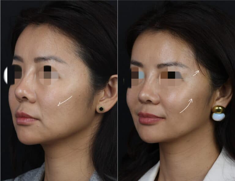 Microlift to rejuvenate the midface of a female patient by Dr. Miller. After surgery, cheeks are lifted and more defined to create a more youthful appearance.