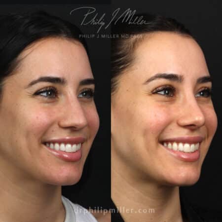 Rhinoplasty and lip lift to improve profile of a female patient by Dr. Miller