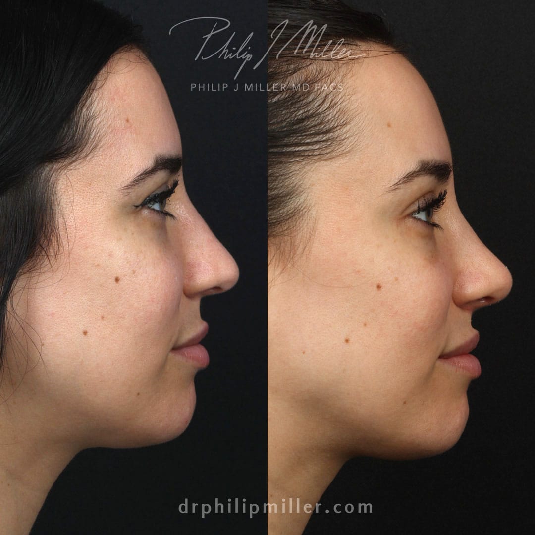 Rhinoplasty and lip lift to improve profile of a female patient by Dr. Miller. After surgery, nasal tip is slightly rotated and philtrum is shorter and more proportionate.