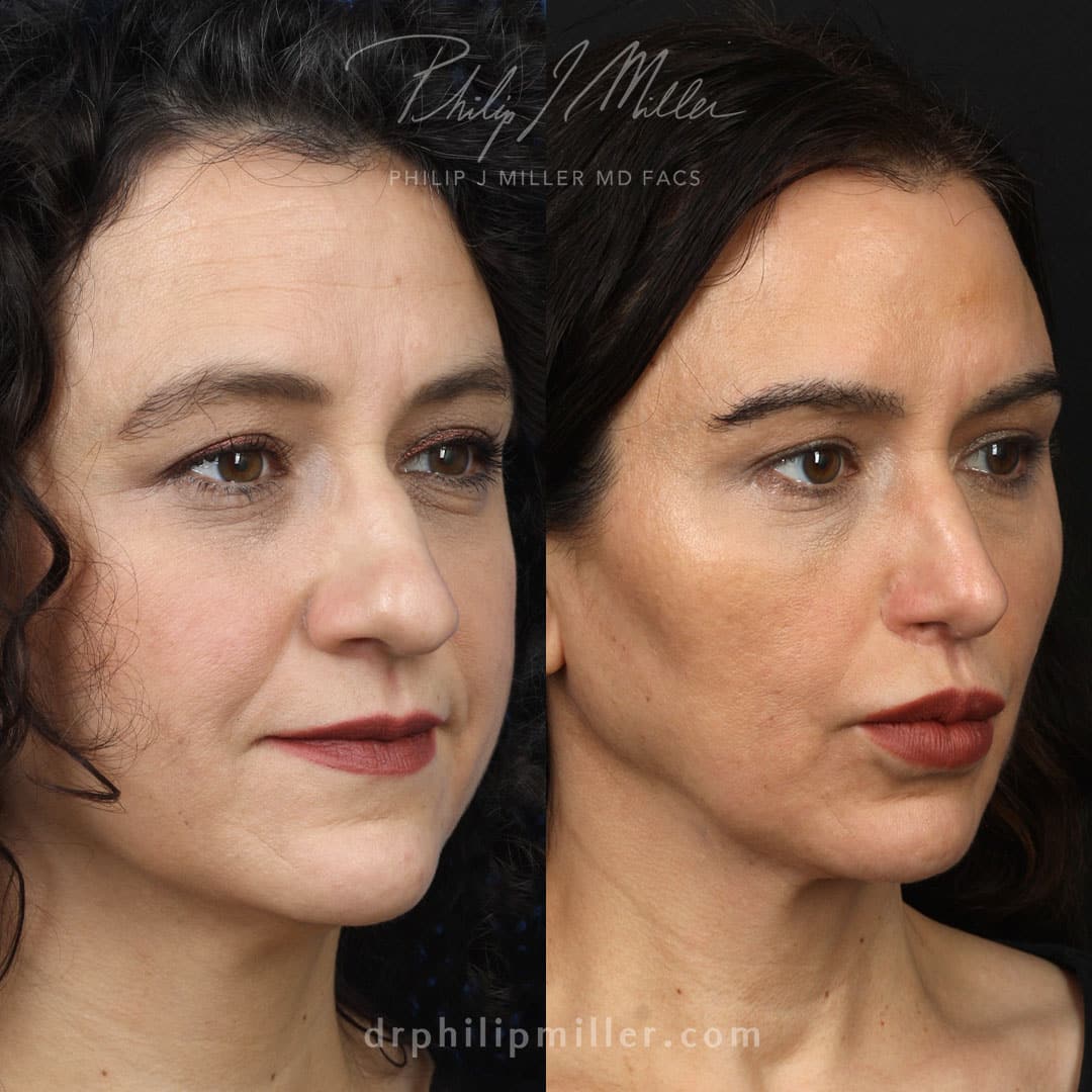 Rhinoplasty and facial fat grafting to enhance the facial contours of a female patient by Dr. Miller. After procedure, cheeks are more defined and nose is proportionate to other facial features.